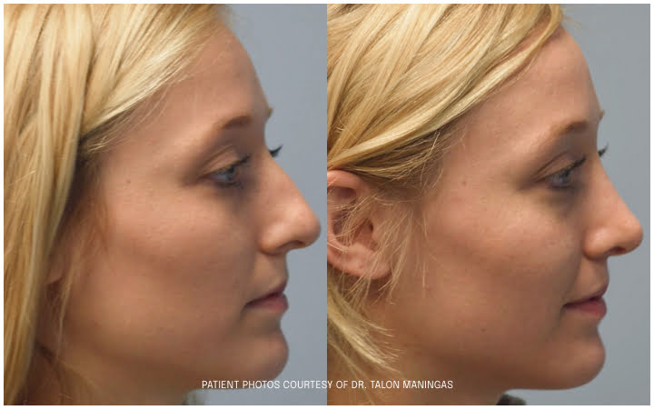rhinoplasty before and after photo side view